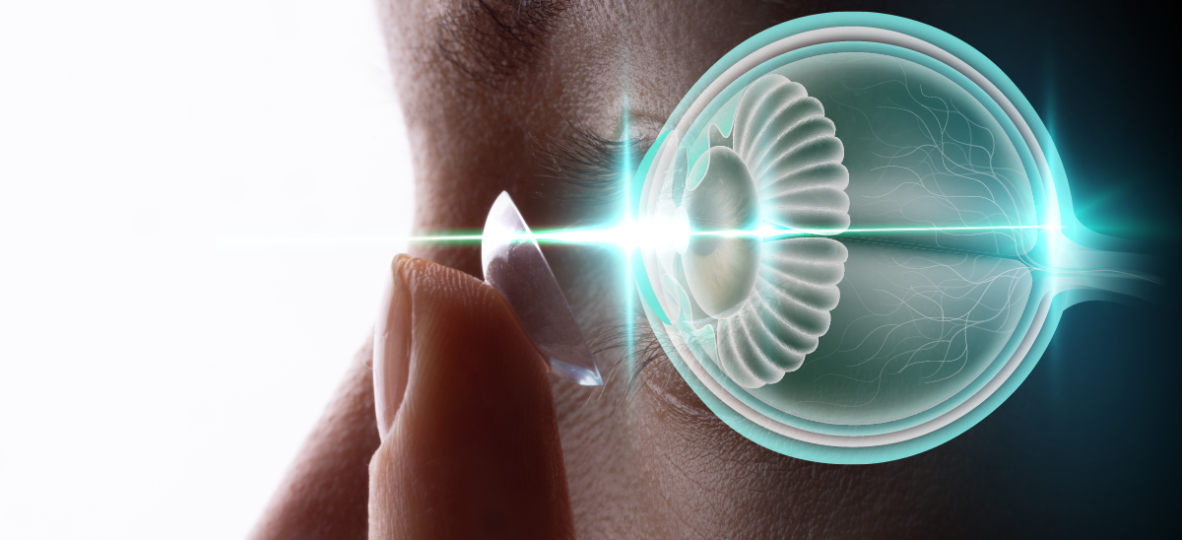 RGPs for myopia progression 01